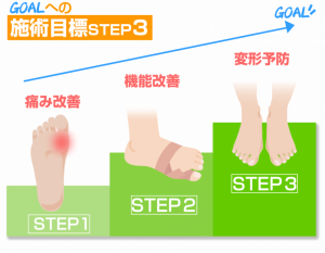「外反母趾」改善の３ステップ